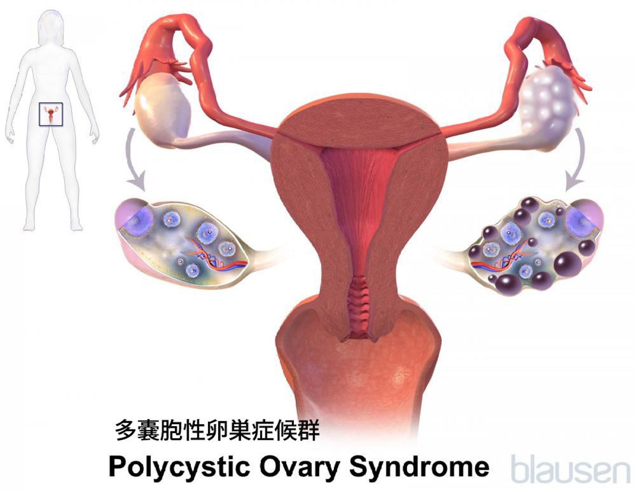 多嚢胞性卵巣症候群（PCOS）