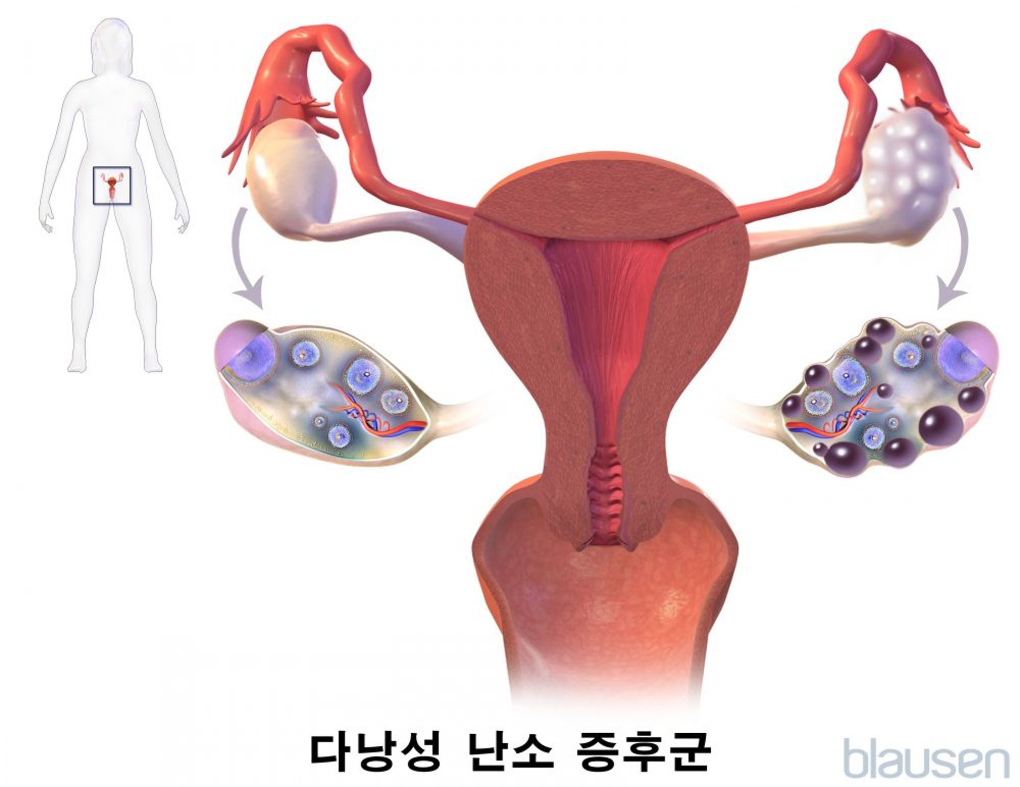 다낭성 난소 증후군(PCOS)