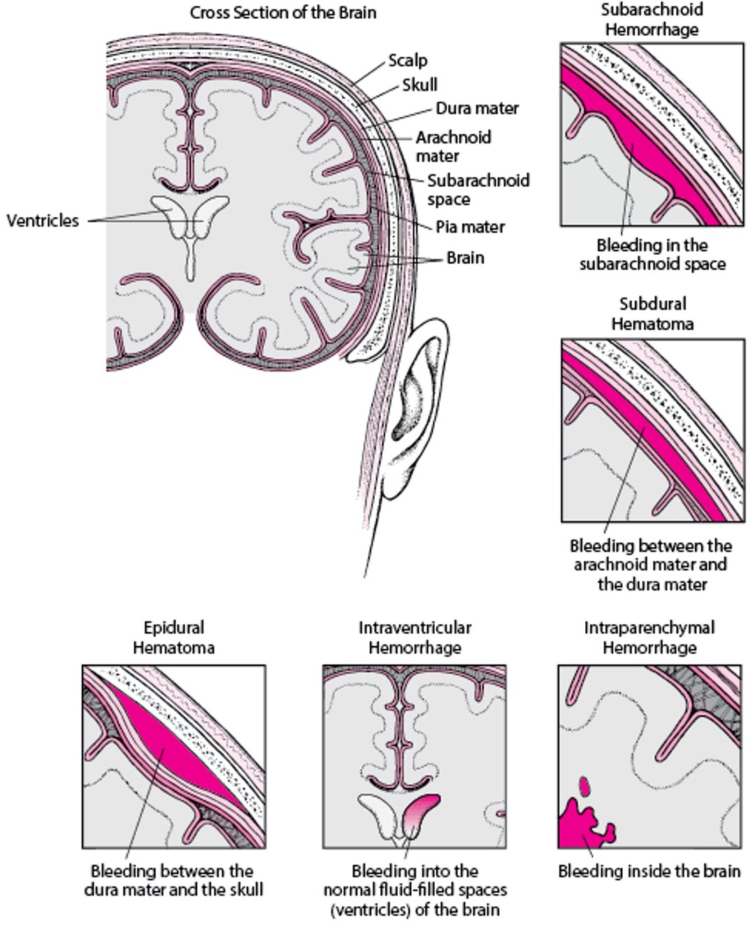 Bleeding In and Around the Brain