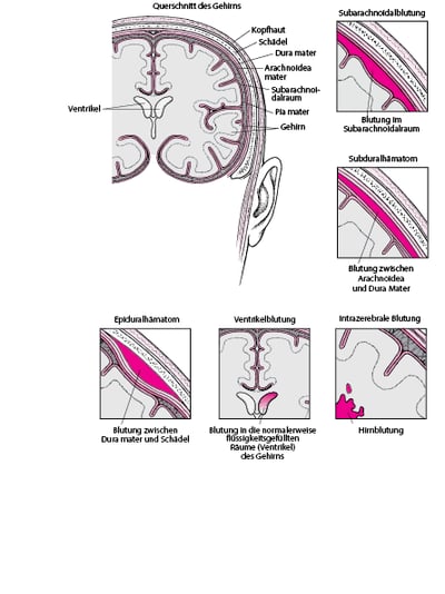 Blutung in und um das Gehirn
