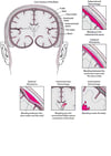 Hemorragia en el interior del cerebro y a su alrededor