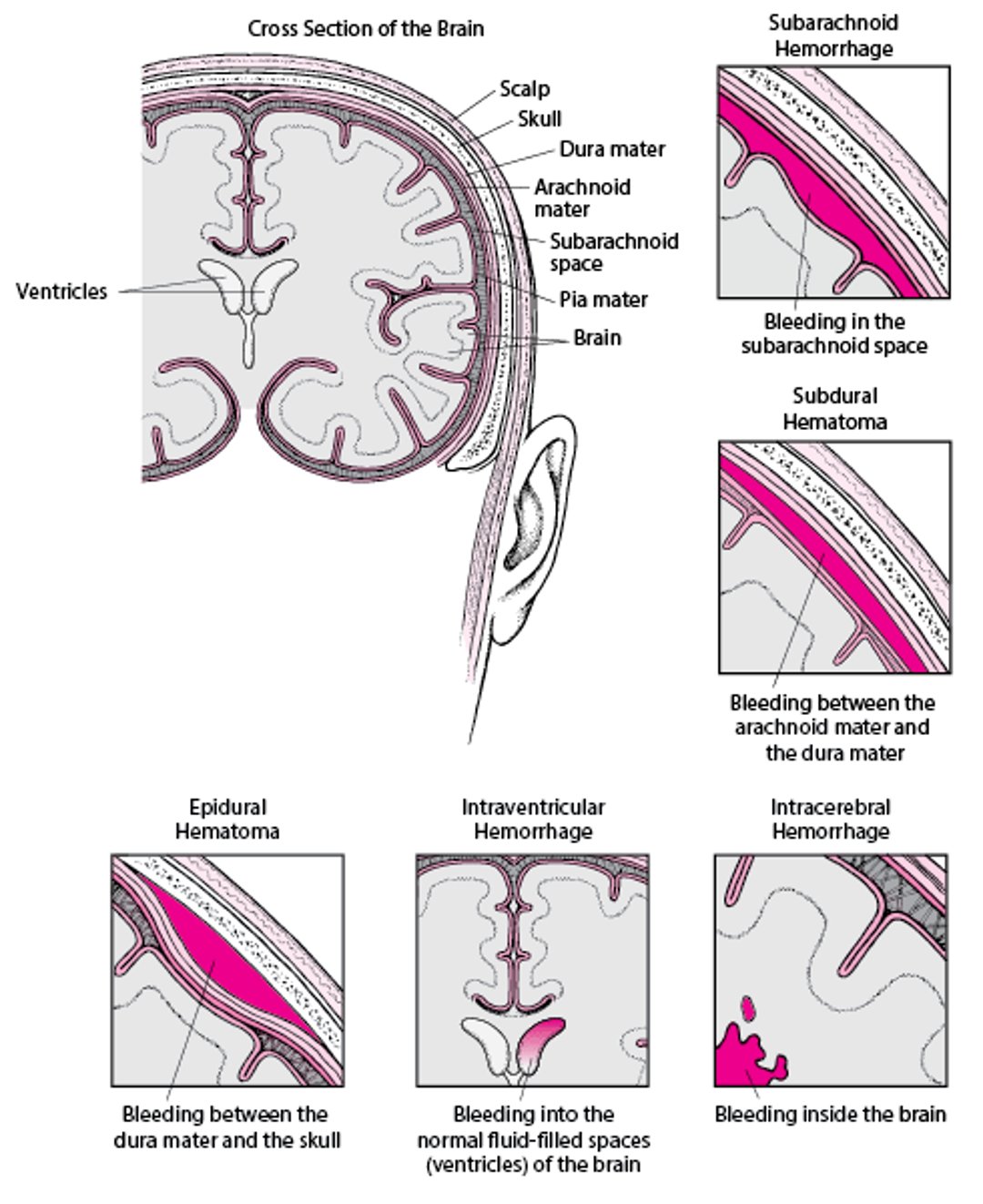 Hemorragia en el interior del cerebro y a su alrededor
