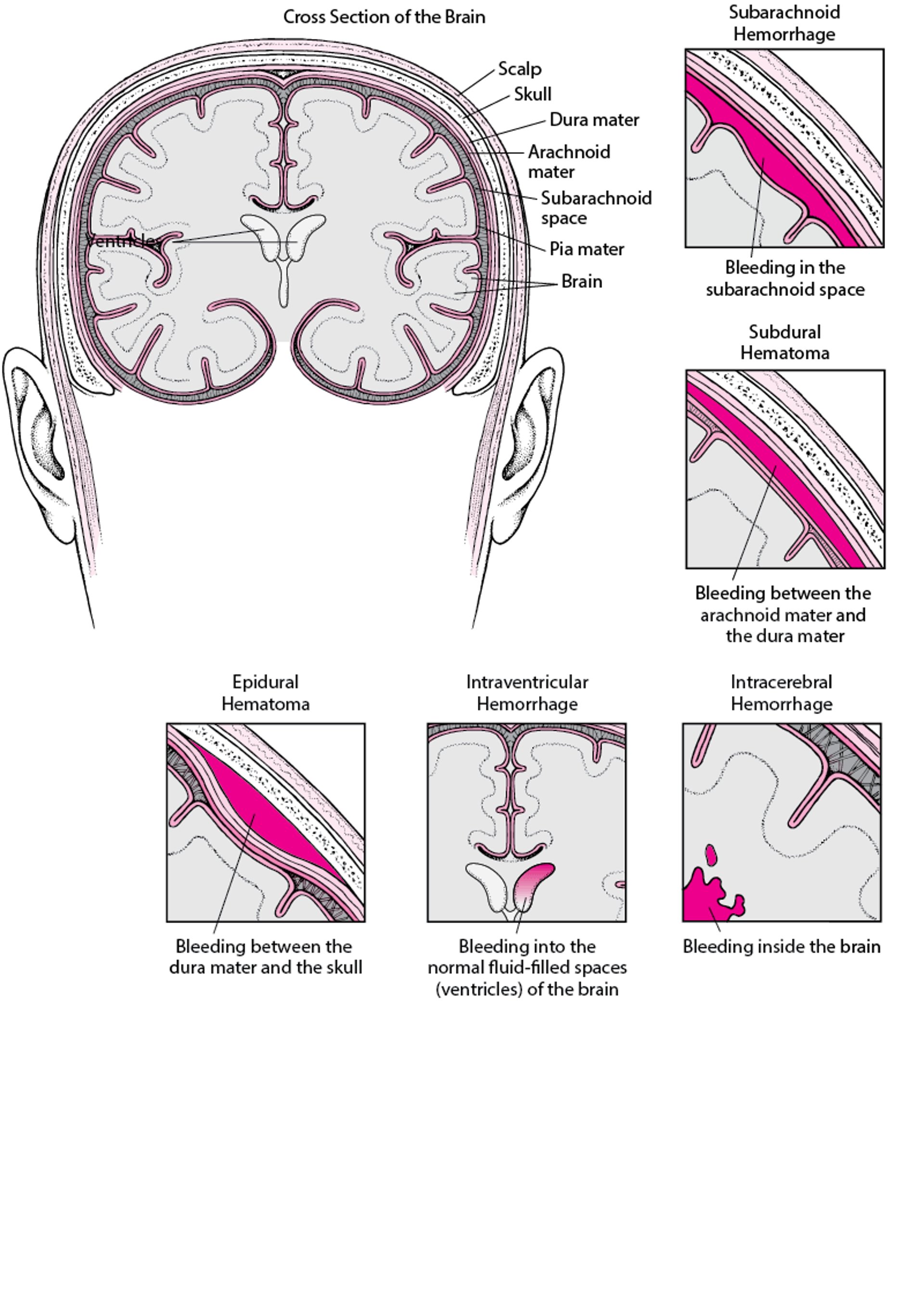Hemorragia en el interior del cerebro y a su alrededor