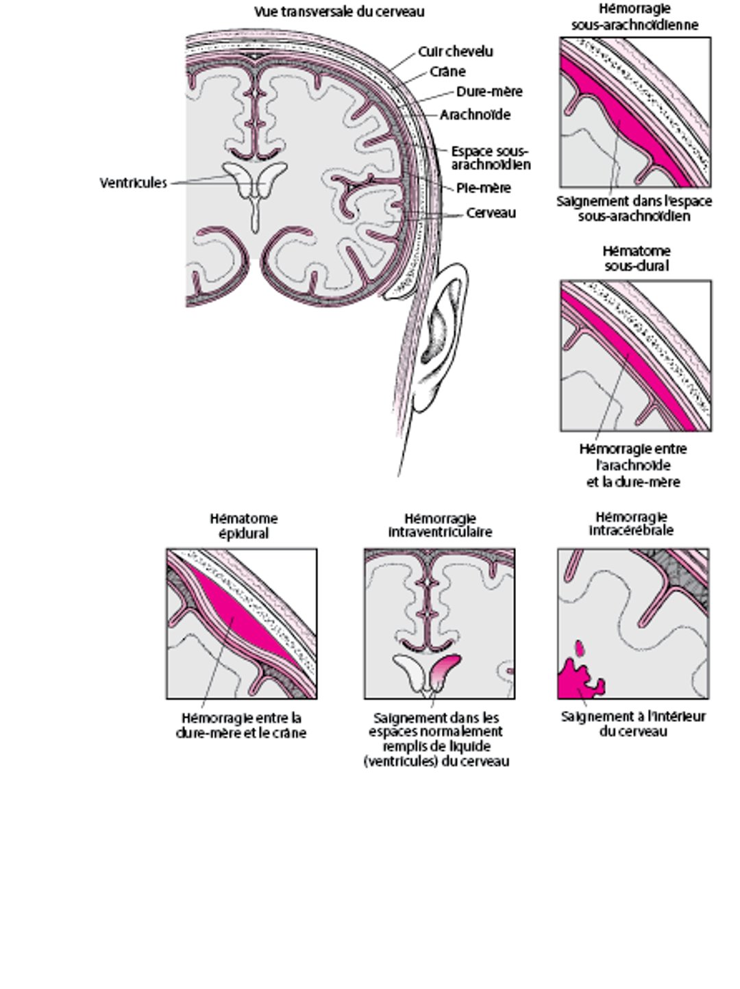 Saignement dans et autour du cerveau