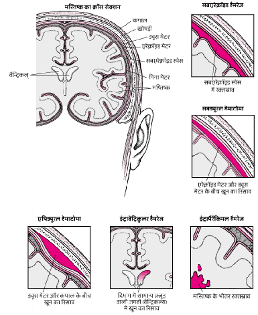 मस्तिष्क में तथा उसके आसपास रक्त का रिसाव