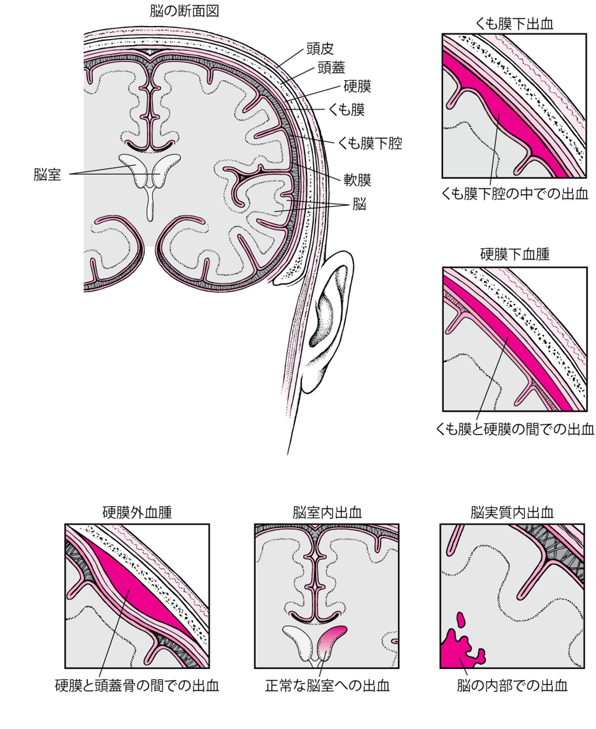 脳内および脳周囲の出血