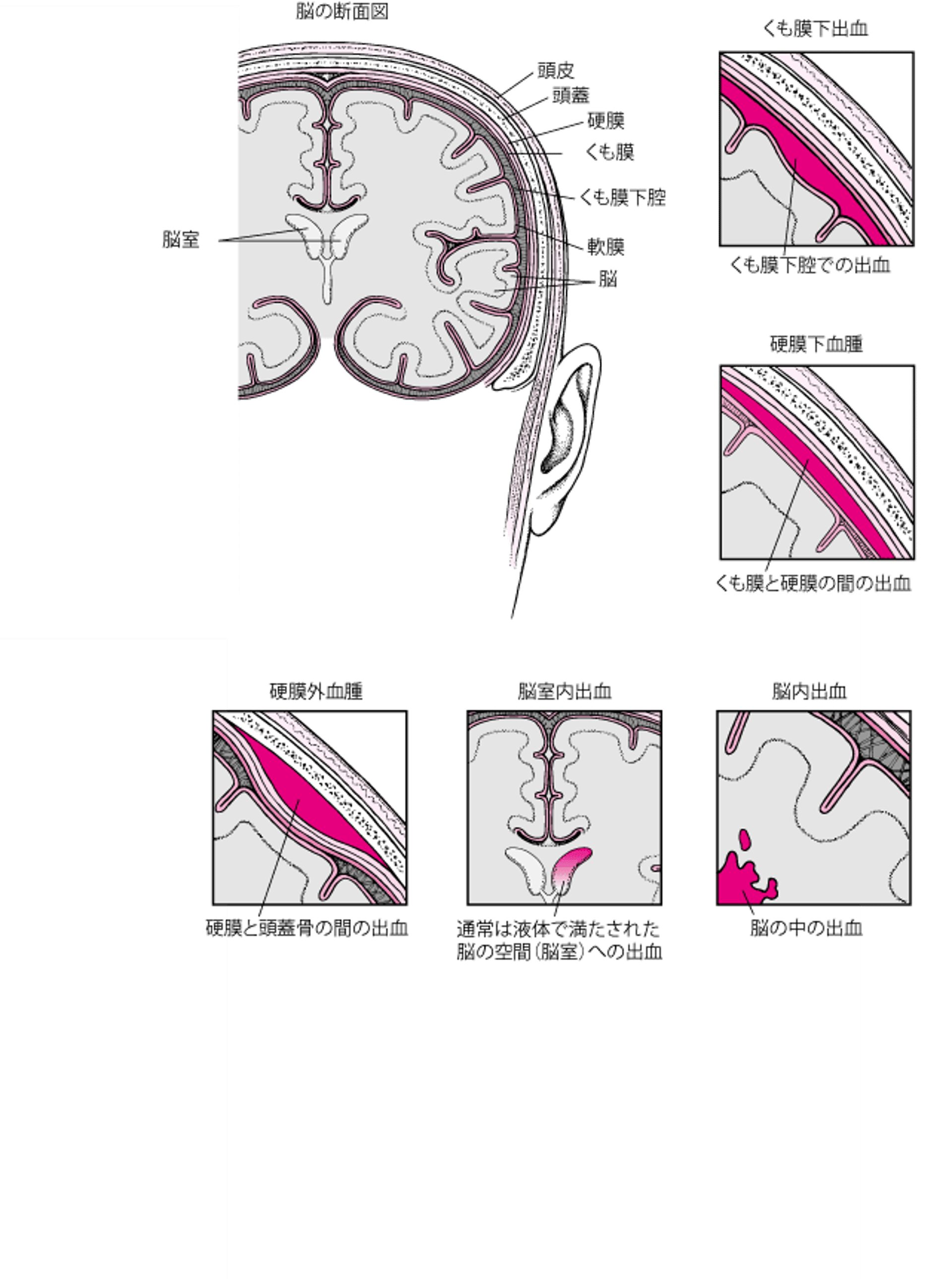 脳の周囲への出血