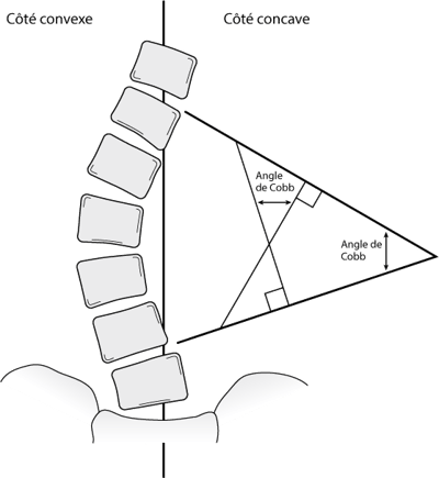 L’angle de Cobb