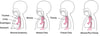 Atresia and Fistula: Defects in the Esophagus