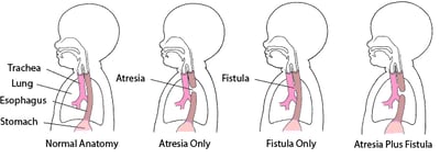 Atresia and Fistula: Defects in the Esophagus