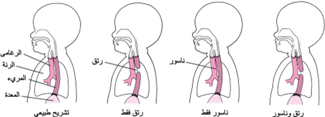 الرتق والناسور: العيوب في المريء