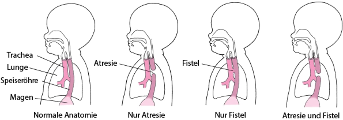 Atresie und Fistel: Defekte der Speiseröhre