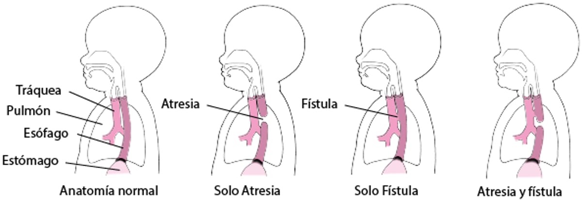 Atresia y fístula: defectos en el esófago