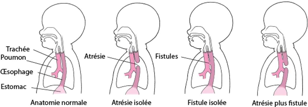 Atrésie et fistule : malformations de l’œsophage
