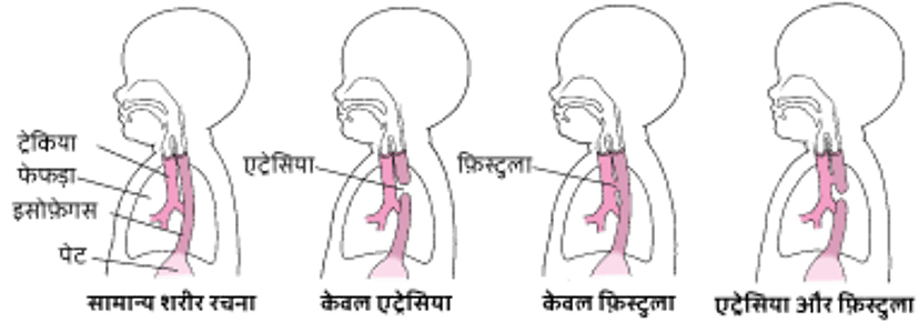 एट्रेसिया और फ़िस्टुला: इसोफ़ेगस में समस्या