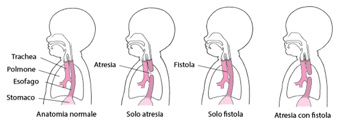 Atresia e fistola: difetti dell’esofago