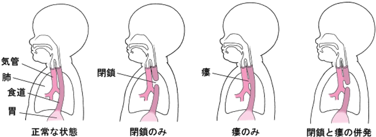 閉鎖へいさと瘻孔ろうこう：食道しょくどうの異常いじょう