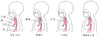 폐쇄와 누공: 식도의 결함