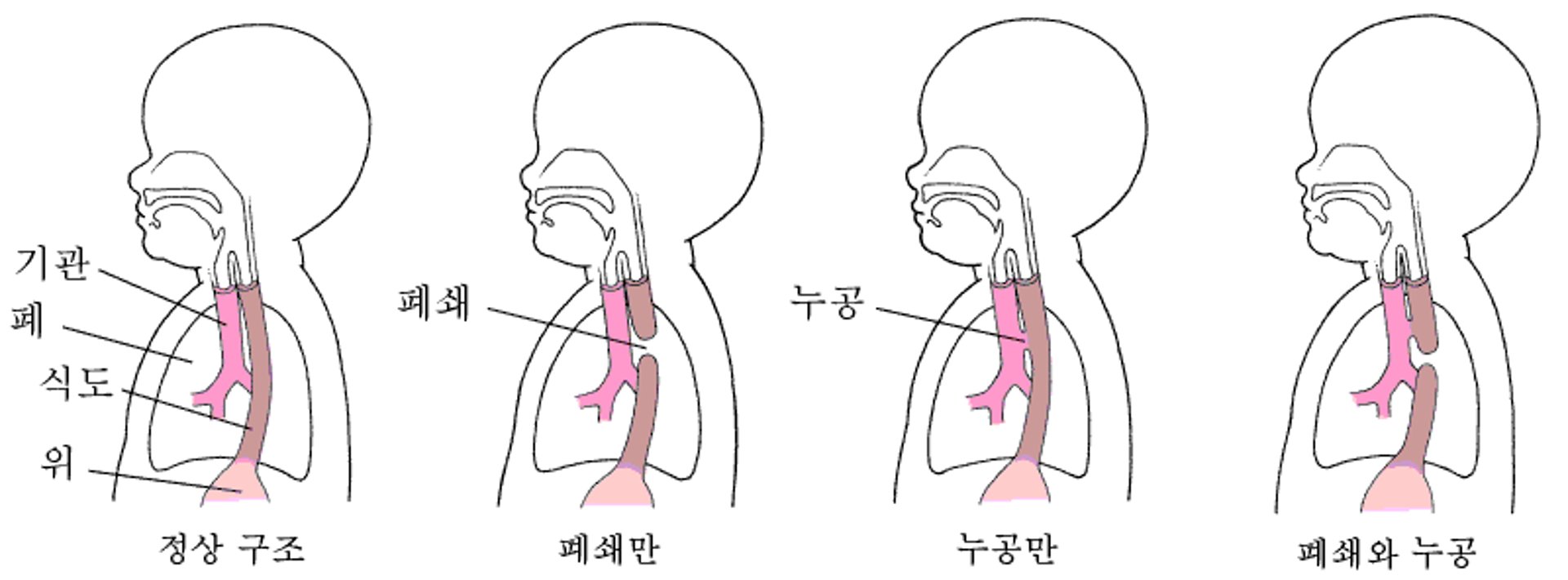 폐쇄와 누공: 식도의 결함