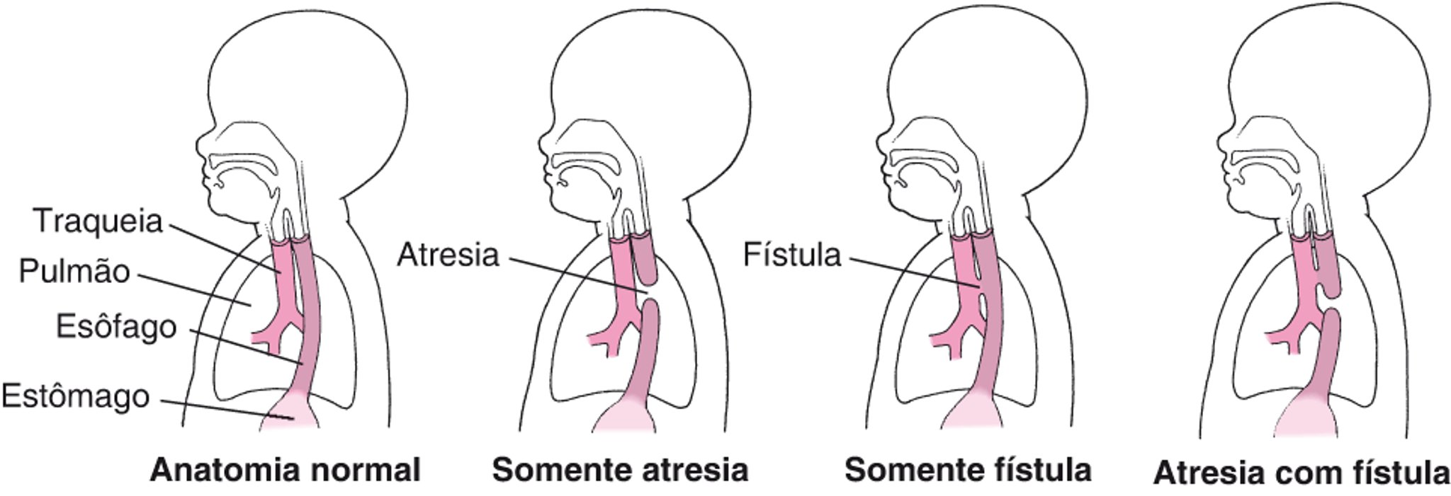Atresia e fístula: Defeitos no esôfago