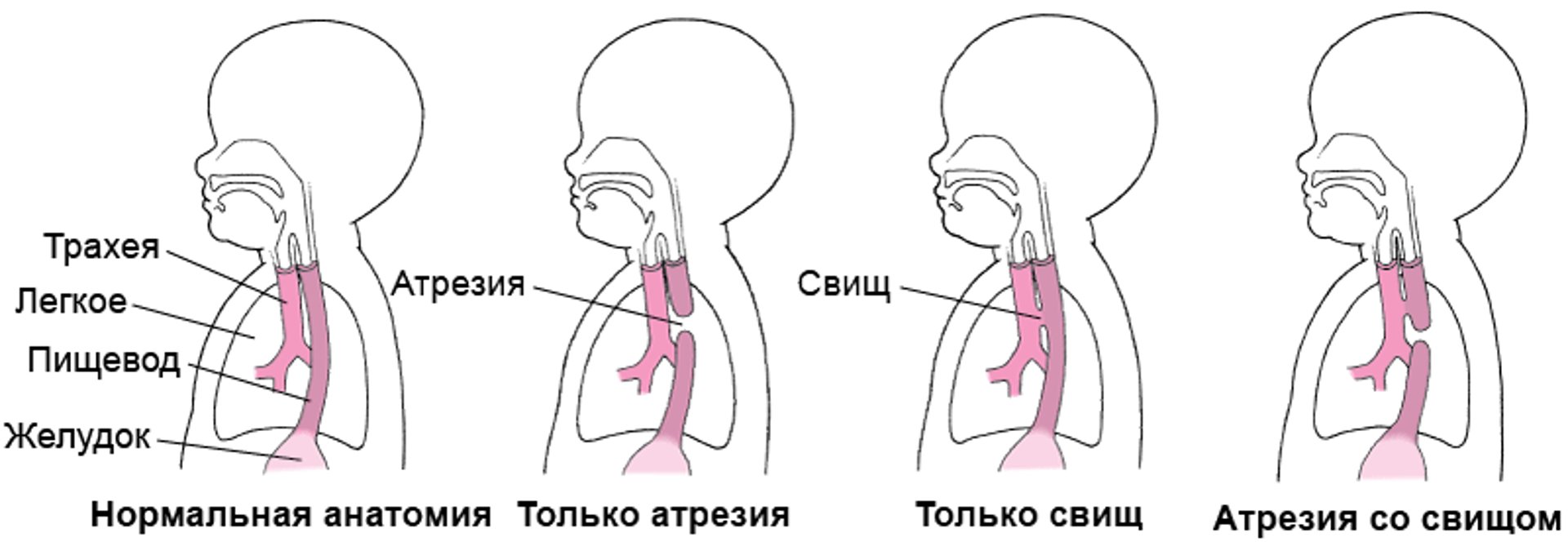 Атрезия и свищ: Дефекты пищевода
