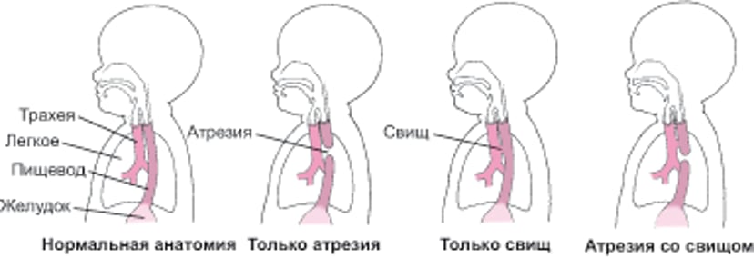 Атрезия и свищ: Дефекты пищевода
