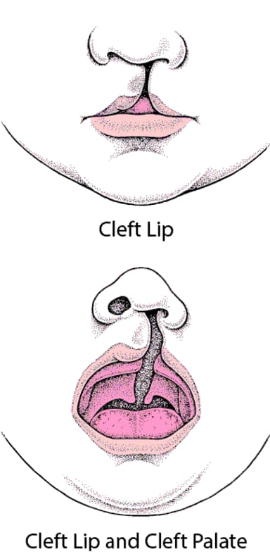 Cleft Lip and Cleft Palate - Children's Health - Merck Manual Consumer ...
