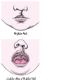 الشفة المَشقُوقَة والحنك المشقُوق: عيوب الوجه