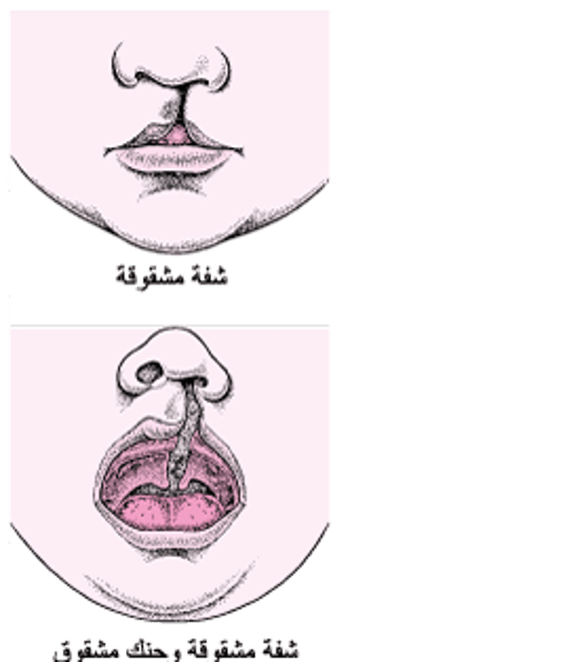 الشفة المَشقُوقَة والحنك المشقُوق: عيوب الوجه
