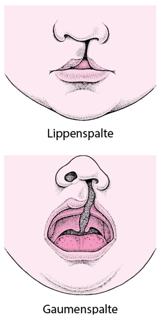 Lippen- und Gaumenspalte: Fehlbildungen des Gesichts