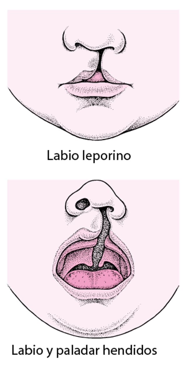 Labio hendido (o leporino) y paladar hendido: defectos faciales
