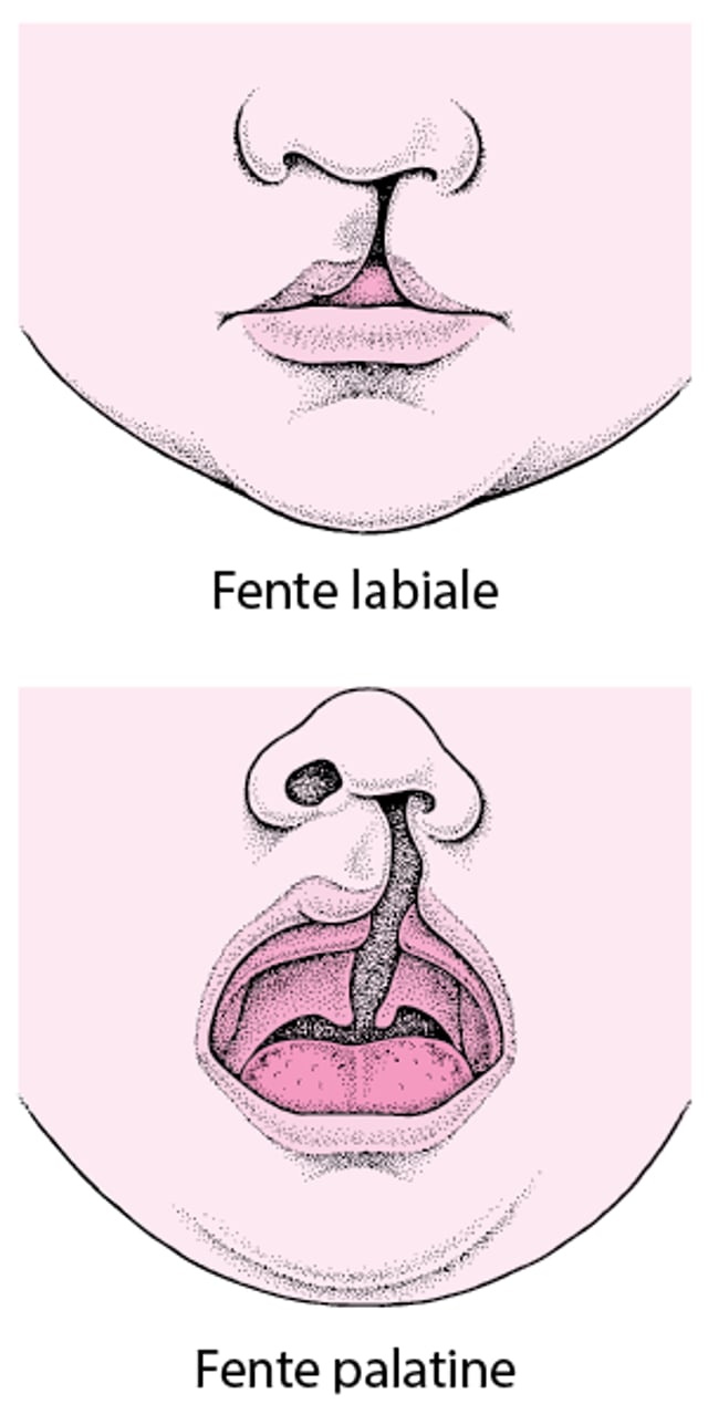 Fente labiale et fente palatine : malformations du visage