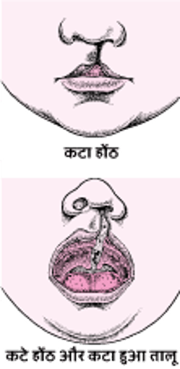 कटे होंठ और कटे तालू: चेहरे के दोष