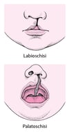 Labbro leporino e palatoschisi: Malformazioni del volto