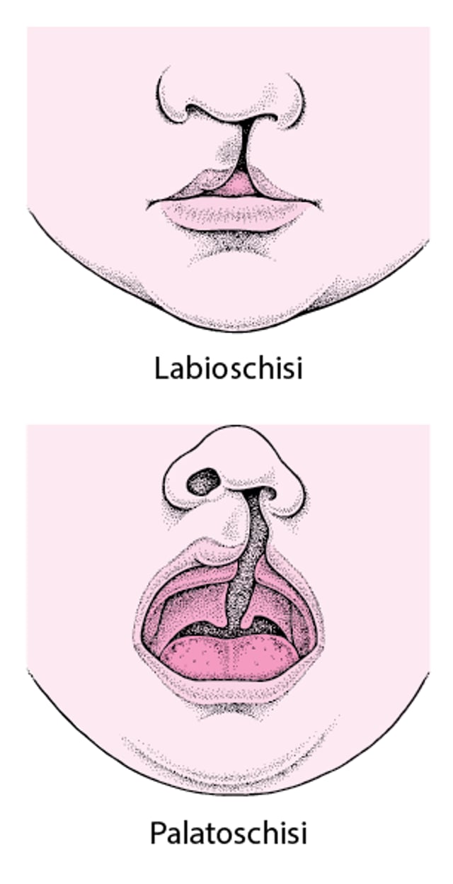 Labbro leporino e palatoschisi: Malformazioni del volto
