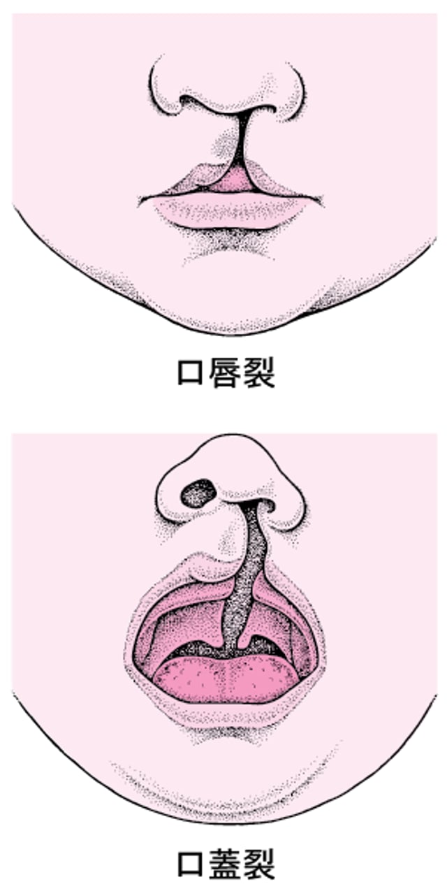 口唇裂と口蓋裂：顔面の異常