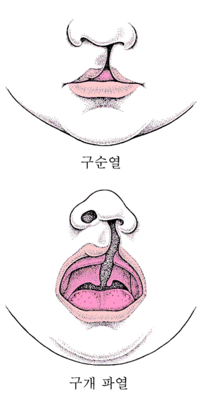 구순열과 구개 파열: 얼굴의 결함