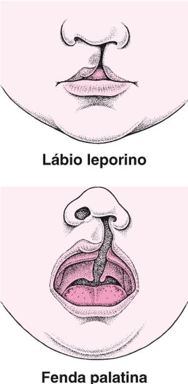 Lábio leporino e fenda palatina - Problemas de saúde infantil - Manual ...