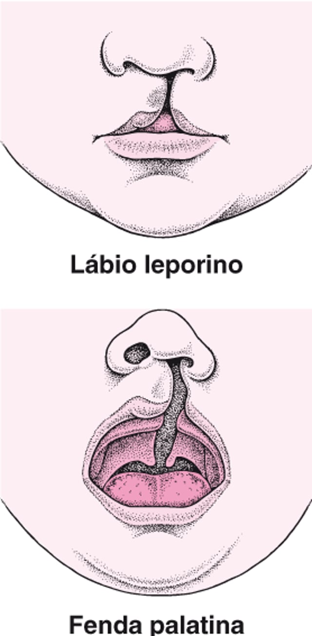 Lábio leporino e fenda palatina: Defeitos da face