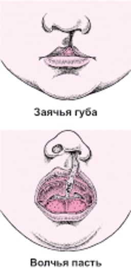 Заячья губа и расщелина неба: Дефекты лица
