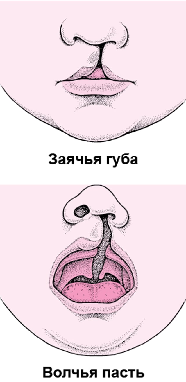 Заячья губа и расщелина неба: Дефекты лица