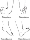 Common Types of Clubfoot