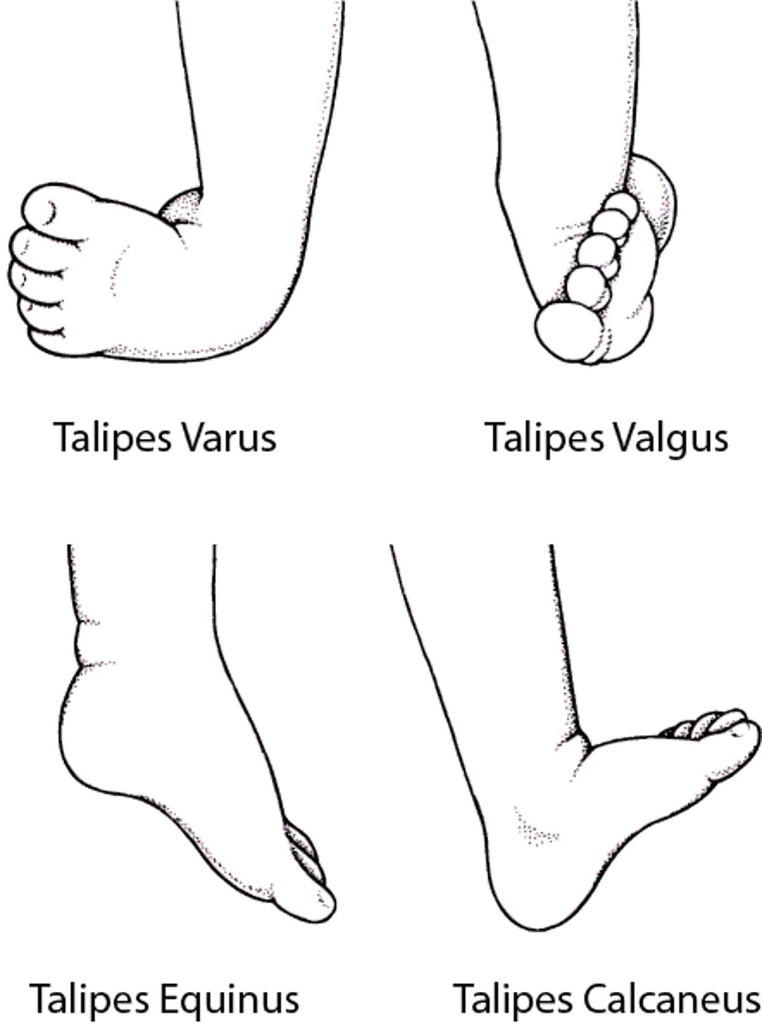 Common Types of Clubfoot