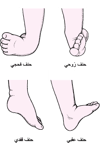 أنواع شائعة لحنف القدَم