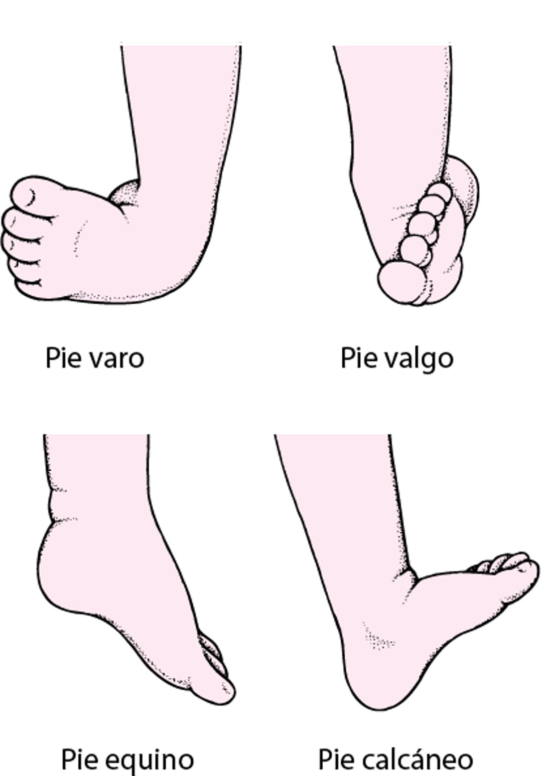 Tipos comunes de pie zambo