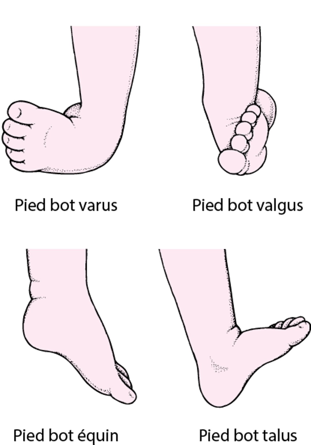 Types de pied bot fréquemment observés