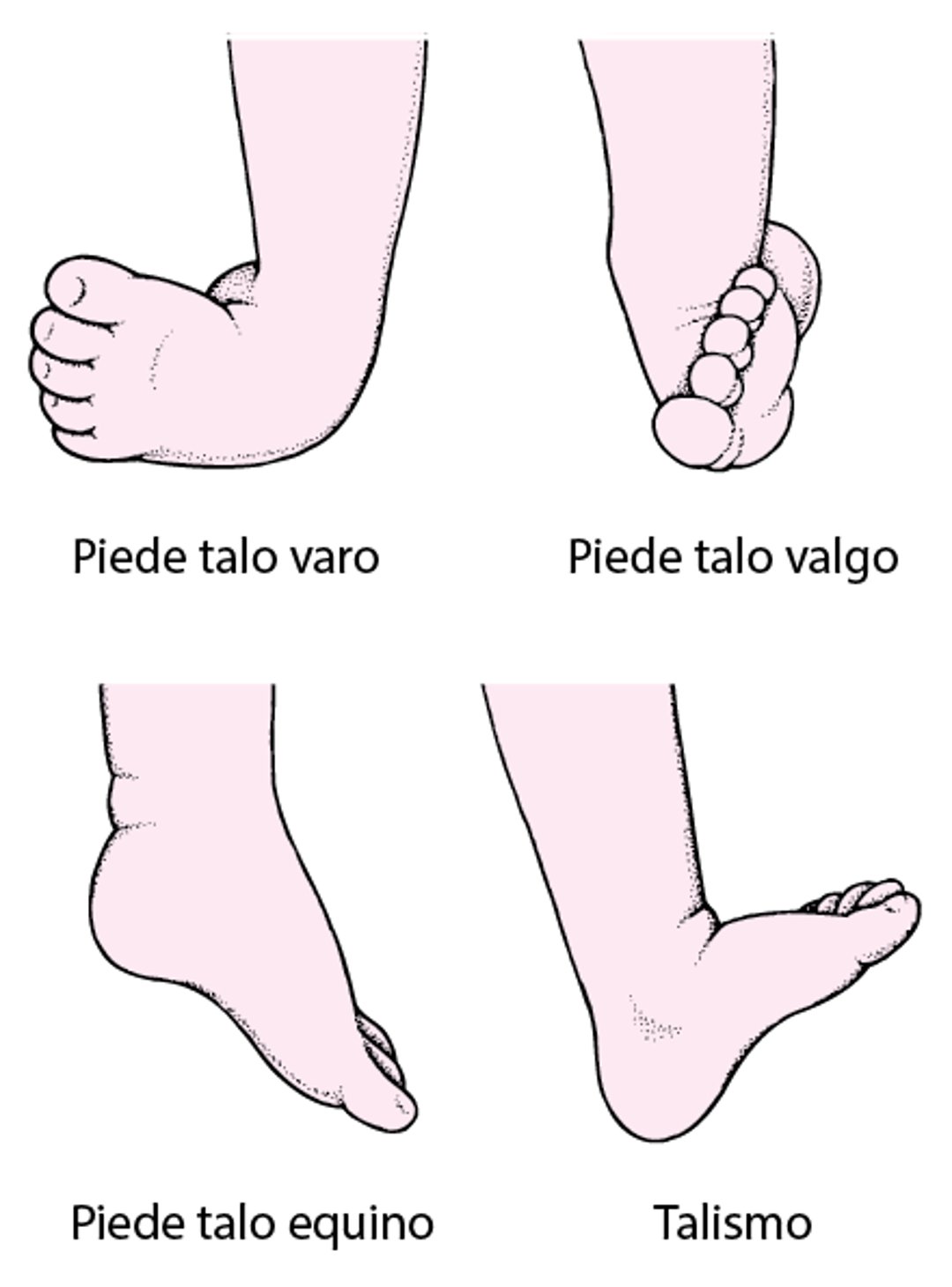 Tipi comuni di piede torto