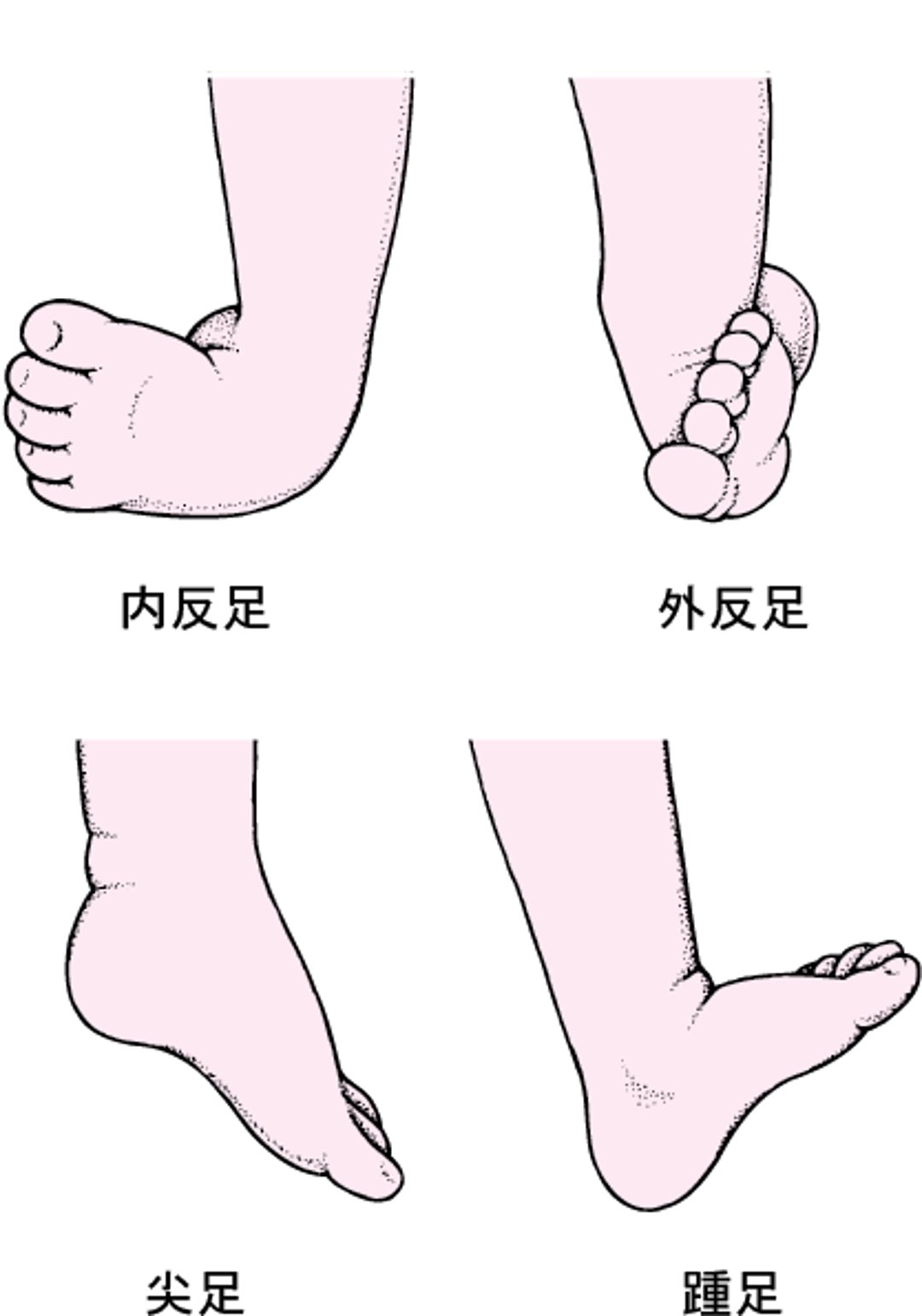 よくみられる内反足