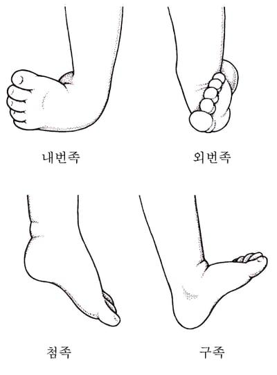 내반족의 보편적 유형