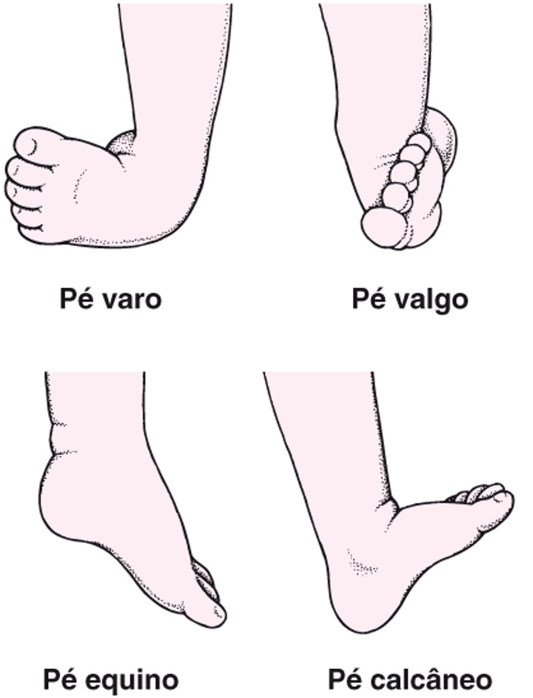 Tipos comuns de pé torto